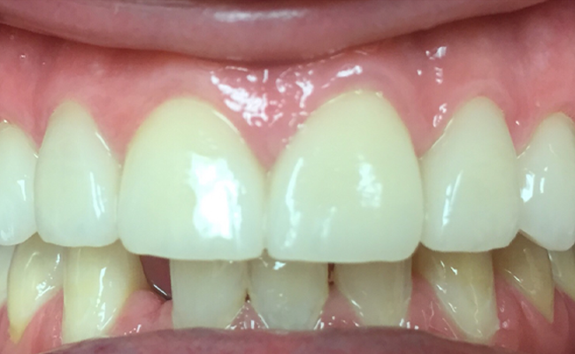 Cosmetic Bonding Restores a New Smile
