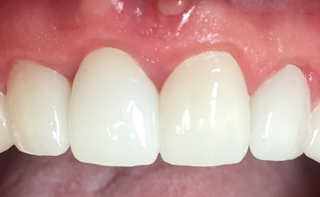 Porcelain Veneers Restores a New Smile